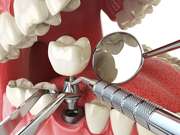Best Urgent Tooth Repair  in Aransas Pass, TX